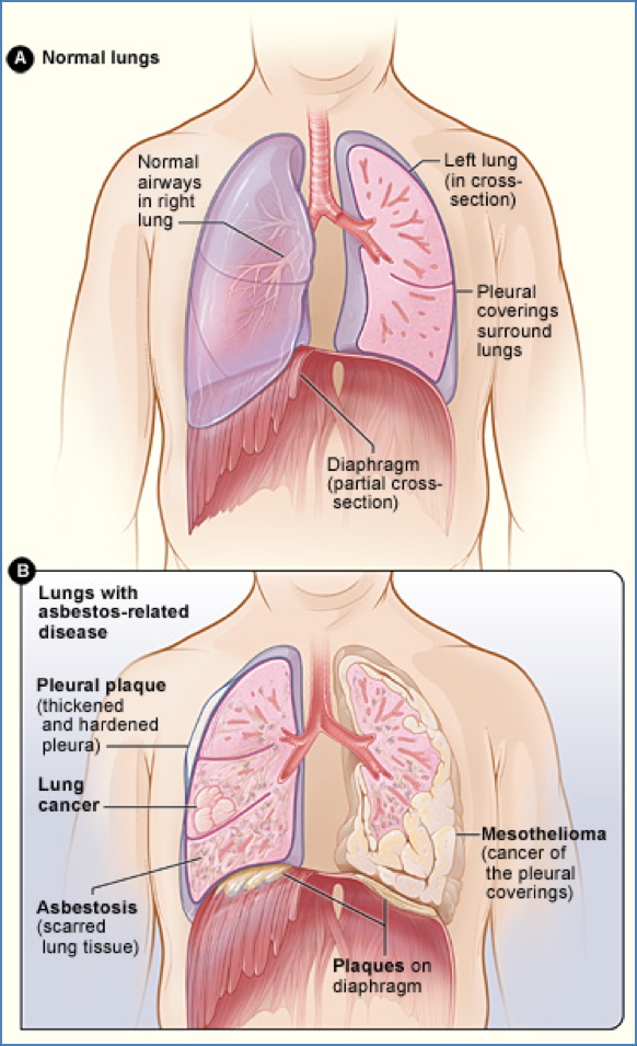 Pneumoconioses: asbestosis