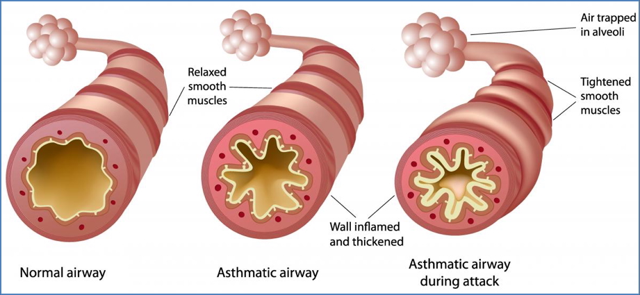 Airway Hypersensitivity and Asthma