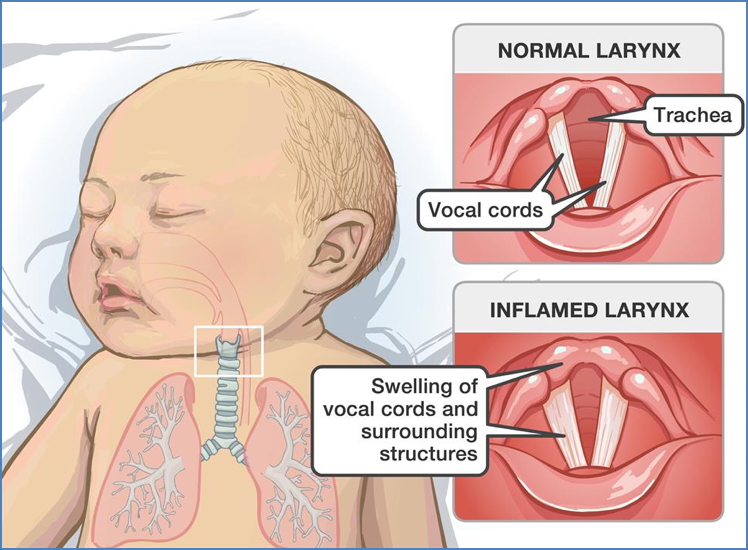 Acute Laryngotracheobronchitis (Croup)
