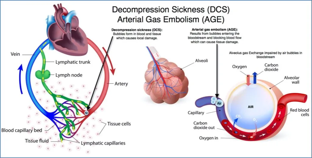 Hyperbaric and Hypobaric Physiology - decompression sickness