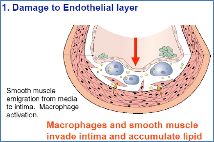 Endothelial damage in atherosclerosis