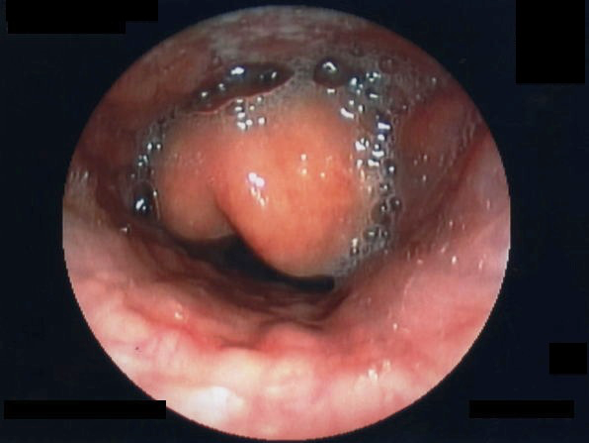 epiglottitis endoscopy