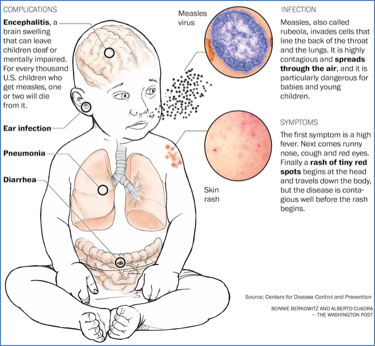 measles - complications