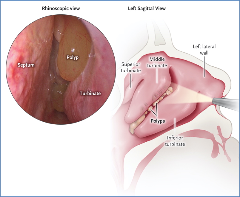 Nasal Tumours - nasal polyps