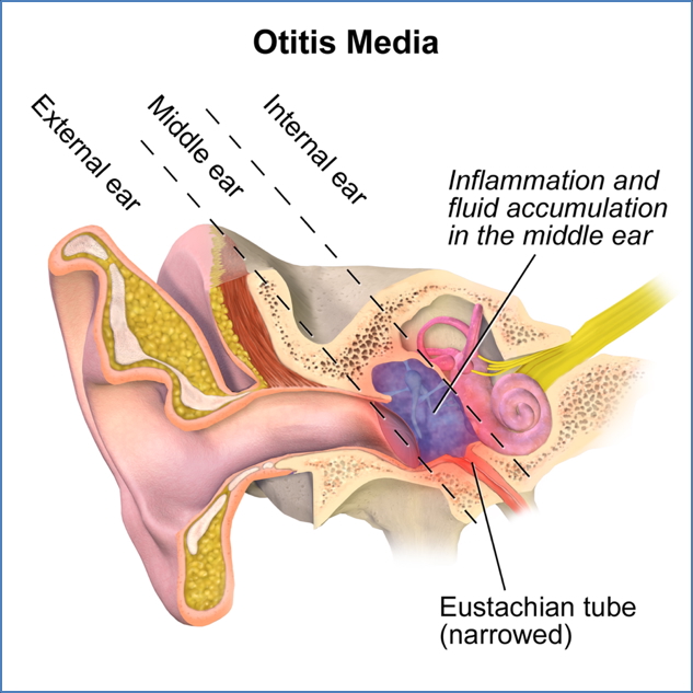 Acute otitis media - eustachian tube dysfunction