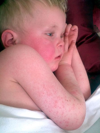 Scarlet Fever - rash