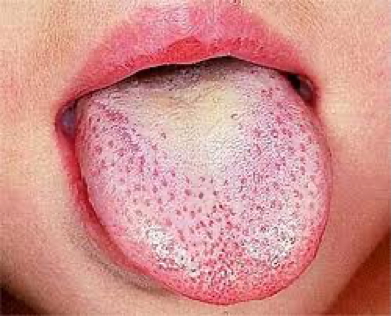 Scarlet Fever - strawberry tongue