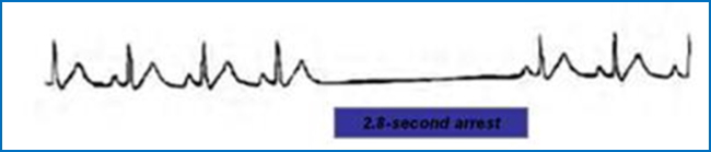 Sinus arrest