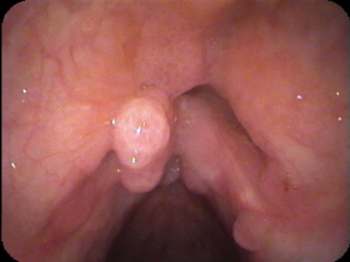 vocal cord papilloma