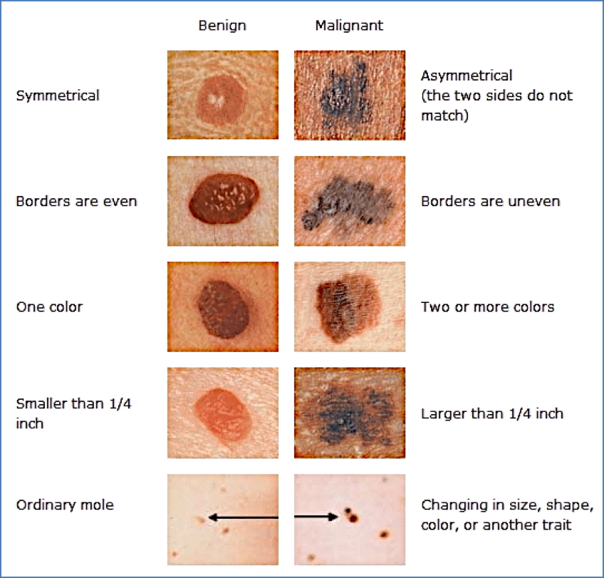 ABCD’s of melanoma