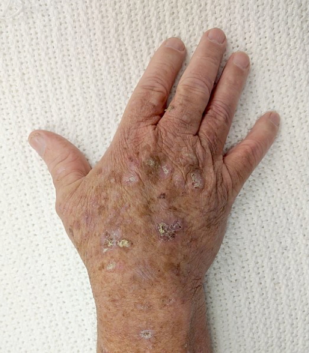 ACTINIC KERATOSIS