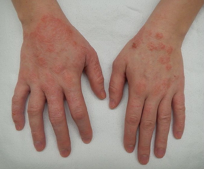 ACUTE DERMATITIS