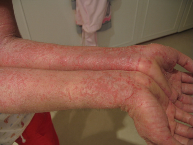 ACUTE DERMATITIS