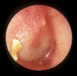Ear infections - ACUTE OTITIS MEDIA