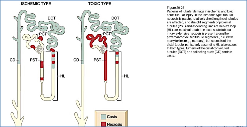 ACUTE TUBULAR NECROSIS