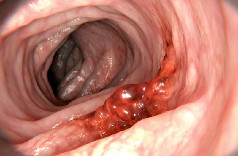 polyps & colon cancer - ADENOCARCINOMA OF THE COLON