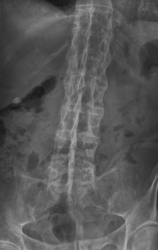 Spine Examination: ANKYLOSING SPONDYLITIS