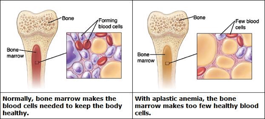APLASTIC ANAEMIA