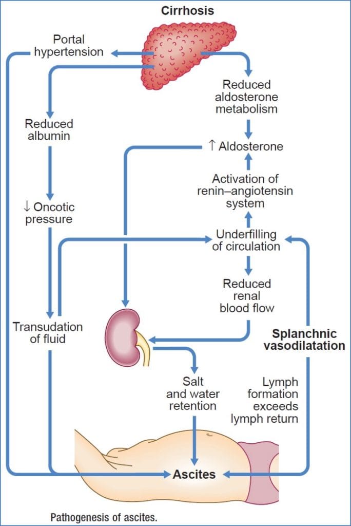 liver failure and cirrhosis - ASCITES