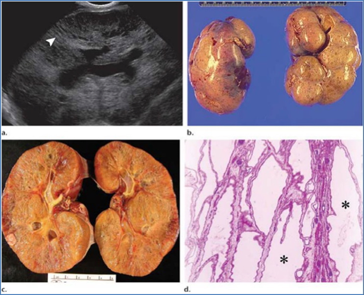 cystic kidney diseases - AUTOSOMAL RECESSIVE POLYCYSTIC Kidney Disease