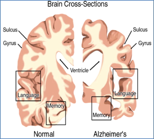 Dementias - Alzheimers