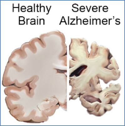Dementias - Alzheimers
