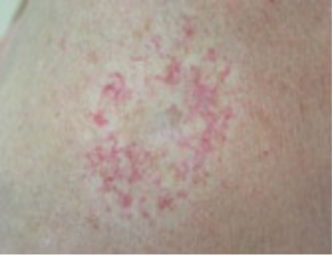 Dermatology Basics - Atrophy