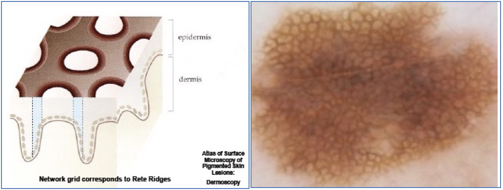 Atypical Pigment Network