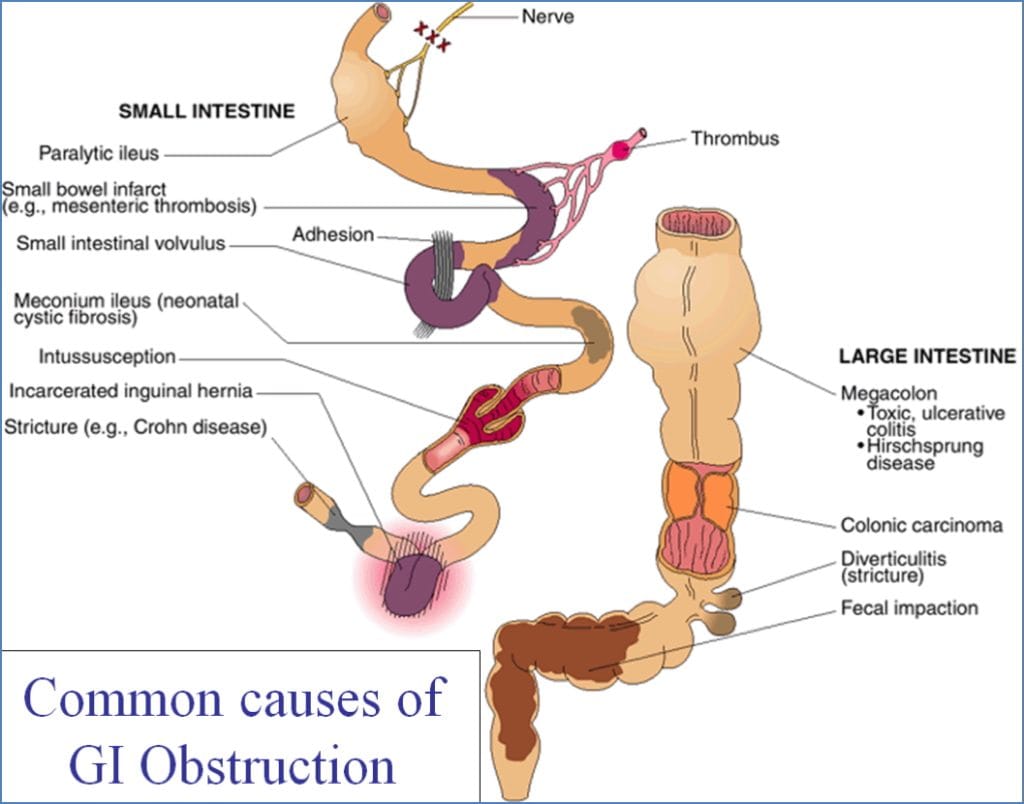 Bowel obstruction causes