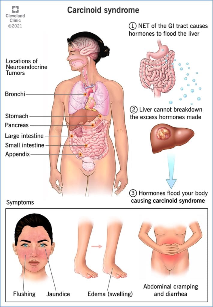 CARCINOID TUMOUR OF THE INTESTINES