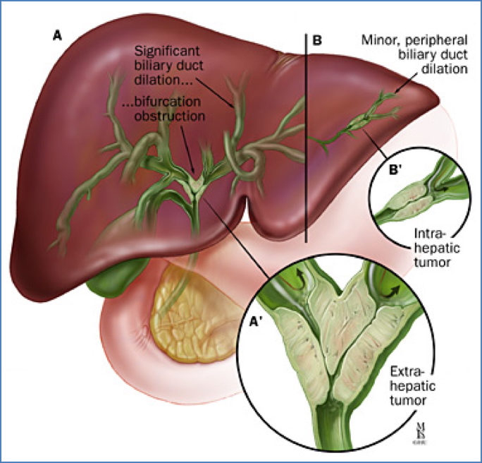 biliary cancers - CHOLANGIOCARCINOMA