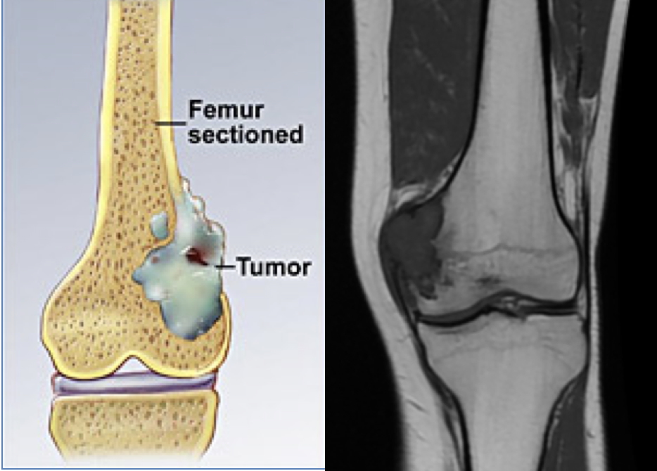 malignant bony tumours - Chondrosarcoma