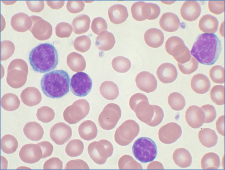 CHRONIC LYMPHOCYTIC LEUKAEMIA