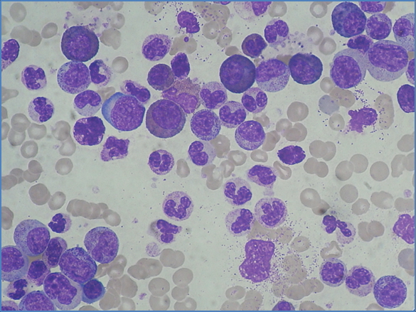 CHRONIC MYELOID LEUKAEMIA