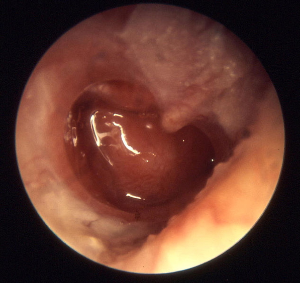 ear infections - CHRONIC OTITIS MEDIA