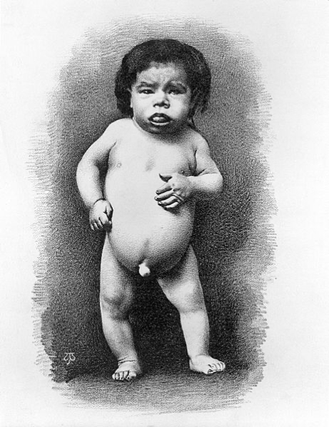 Hypothyroidism - CRETINISM