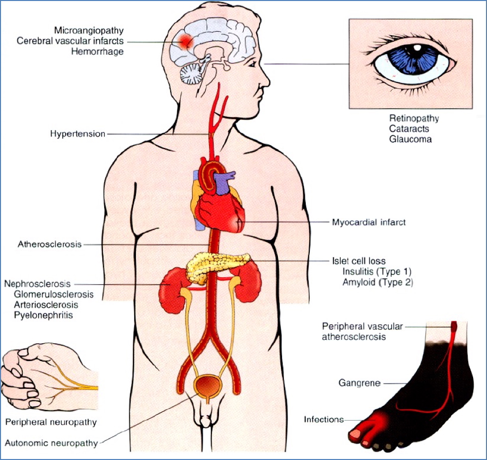 Chronic Complications of diabetes