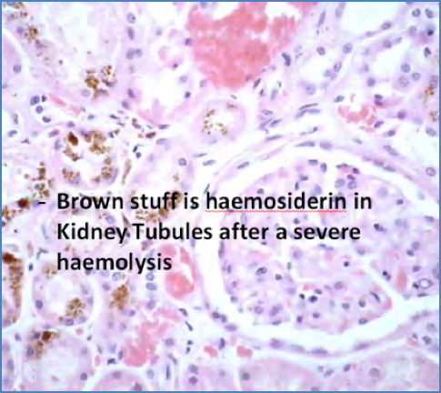 haemolytic anaemia - microscopy