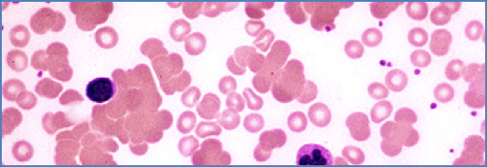 Cold Antibody Autoimmune Haemolytic Anaemia