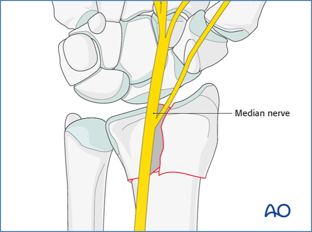 neurovascular compromise - Colles fracture
