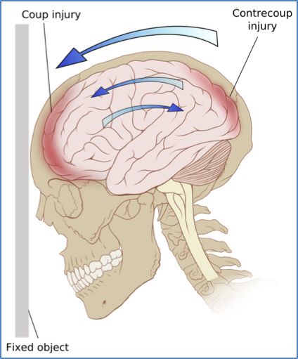 traumatic brain injuries - Contusion