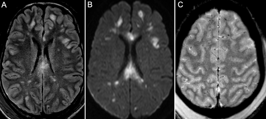 diffuse axonal injury CT