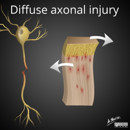 traumatic brain injuries - diffuse axonal injury