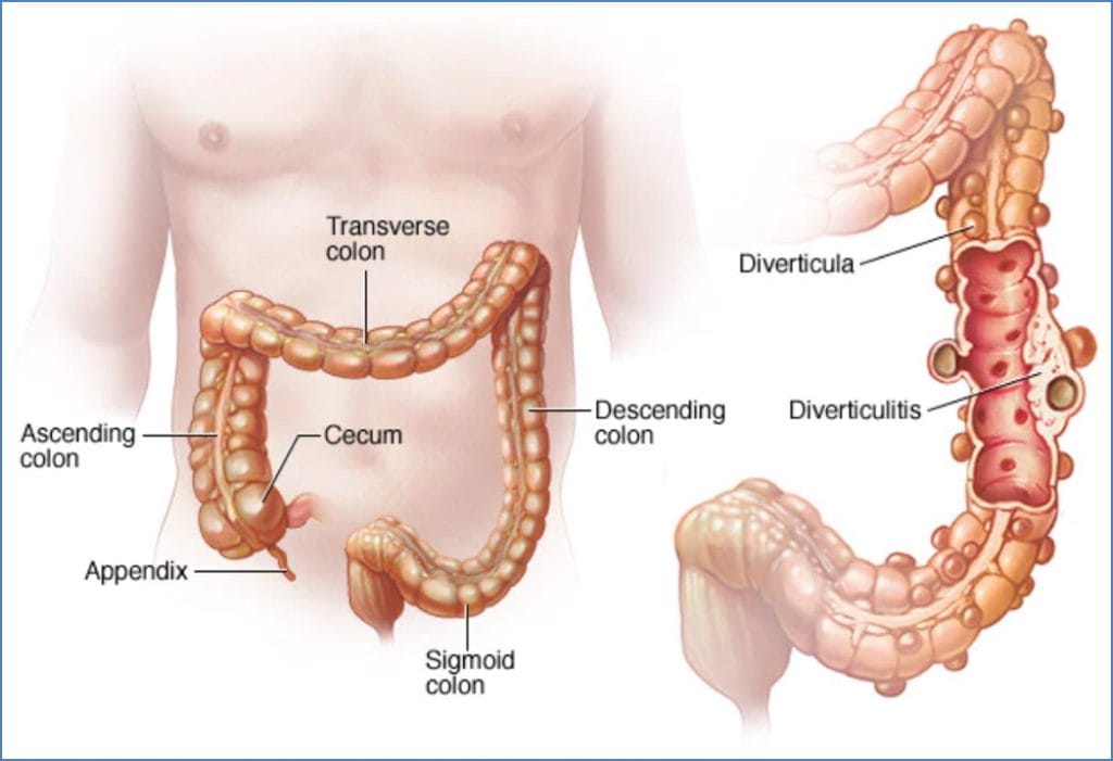 DIVERTICULOSIS