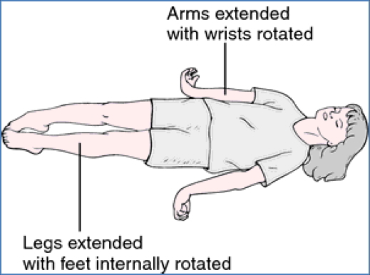 Raised Intracranial pressure - Decerebrate positioning