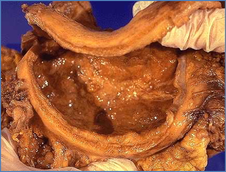 Diffuse (“Leather Bottle”) Adenocarcinoma