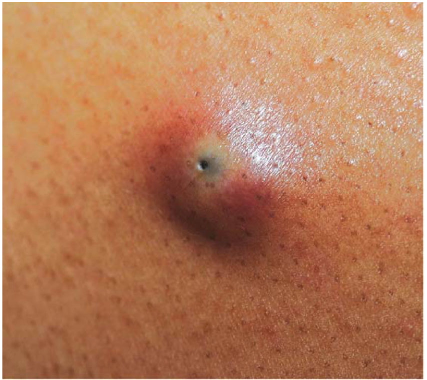 benign skin cysts - EPIDERMAL CYST