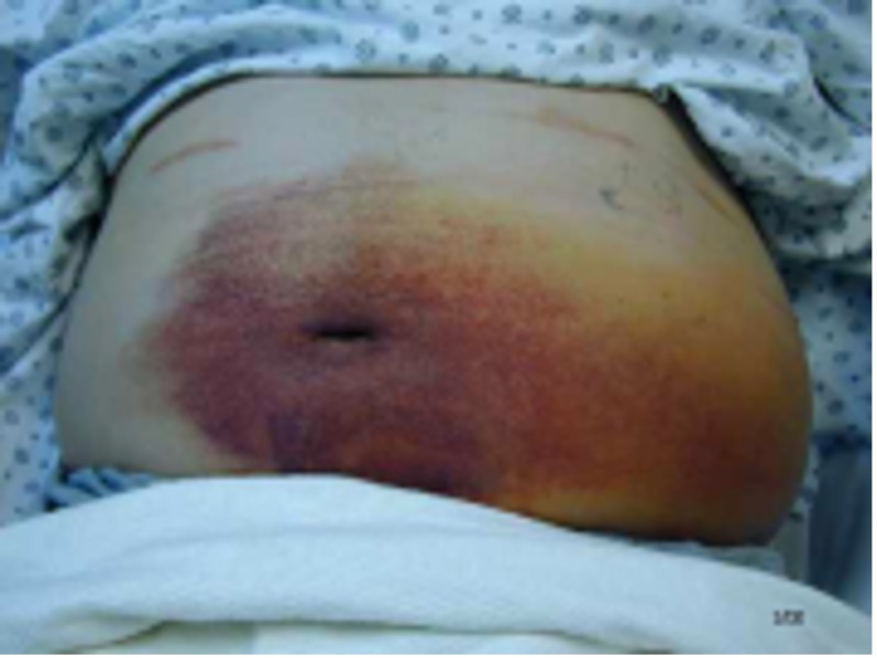 Ecchymosis or Haematoma