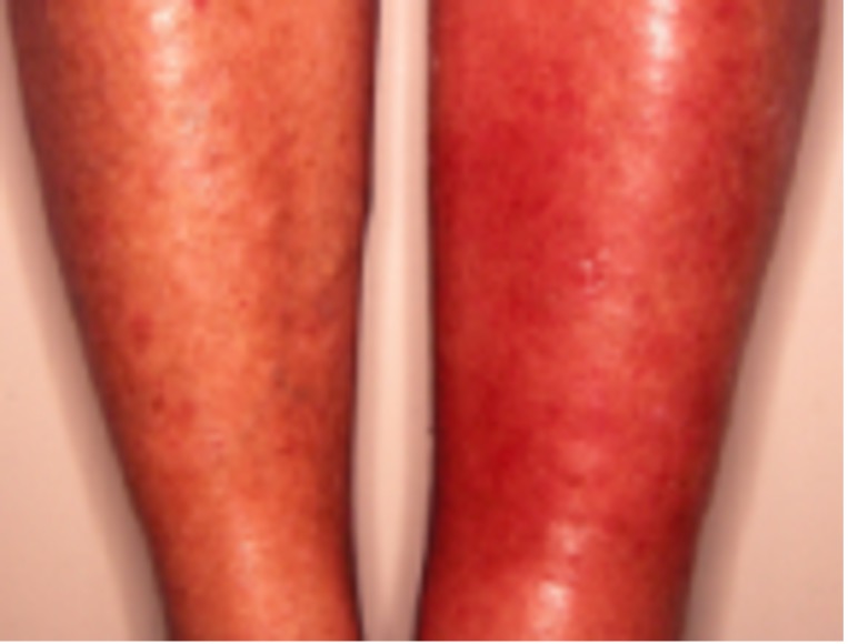 Dermatology Basics - Erythema