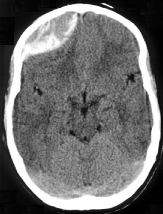 intracranial haemorrhages - Extradural